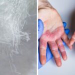 irritación en la piel por contacto con fibra de vidrio